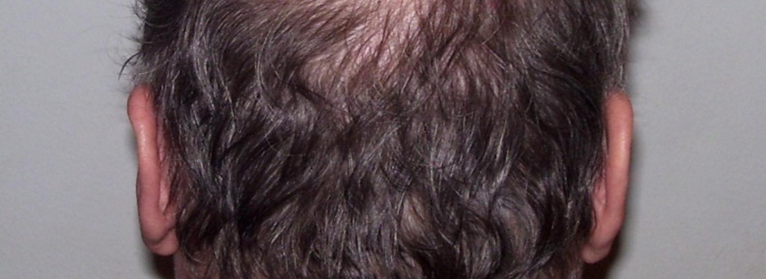 Image of Man Balding on back of the head.