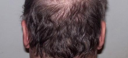 Image of Man Balding on back of the head.